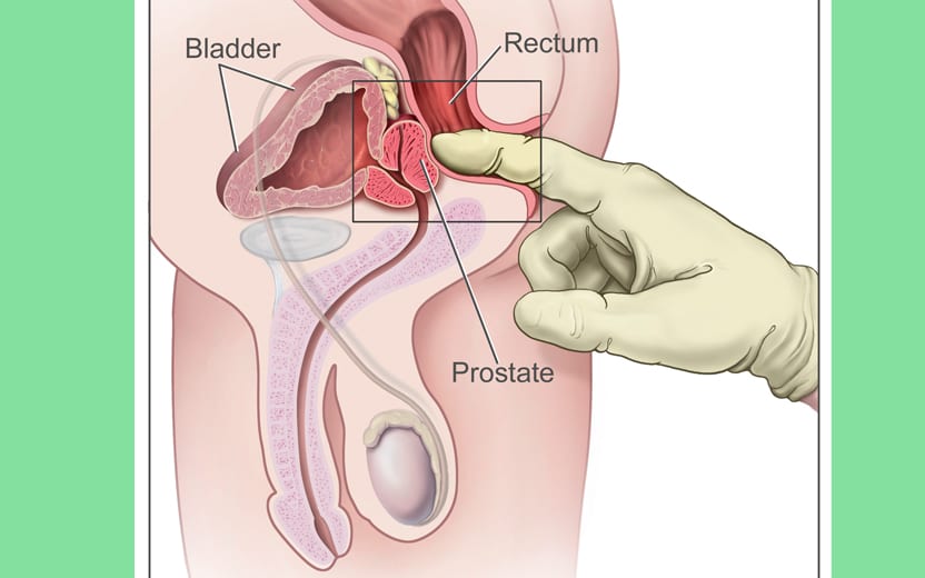 Esquema de como é feito o exame de próstata Câncer de próstata - 2