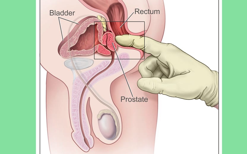 Adenocarcinoma acinar usual na biópsia de próstata | Dr. Paulo Maron