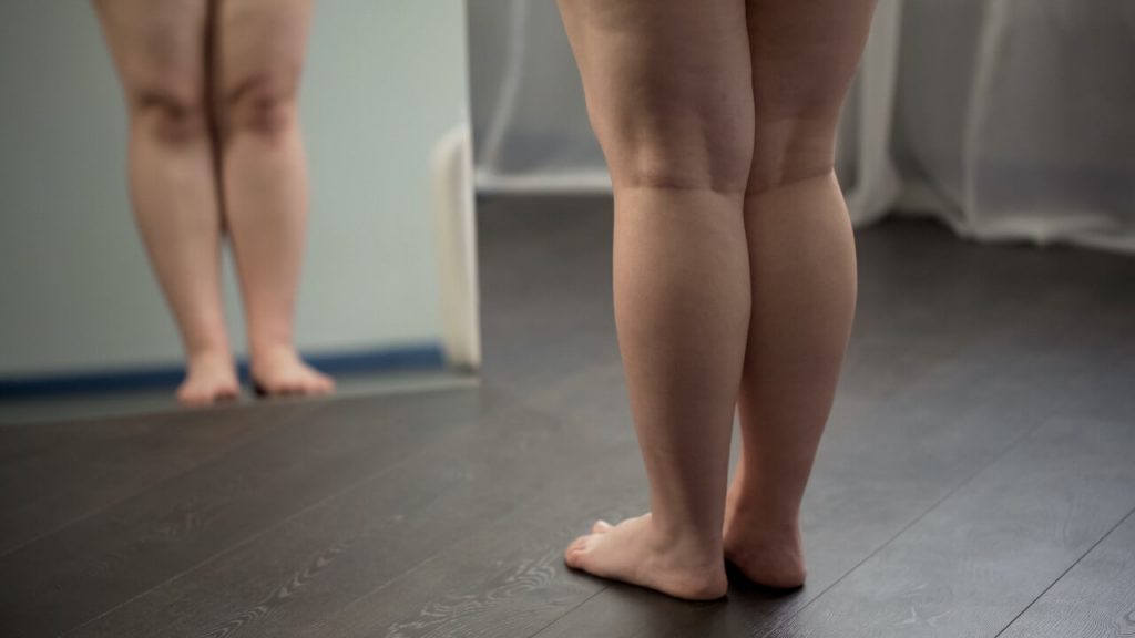 Entenda o lipedema