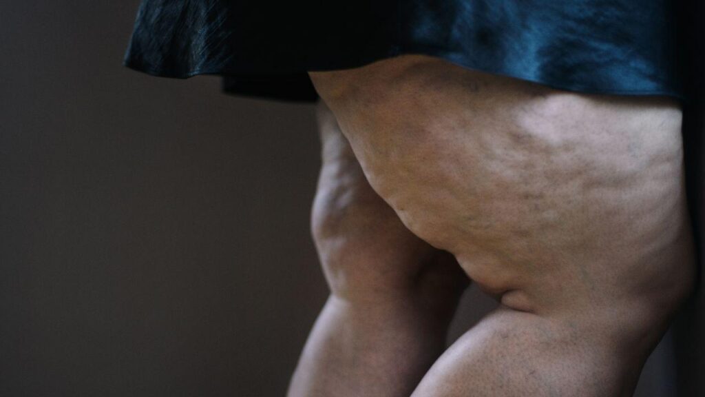 Imagem de uma perna com celilute